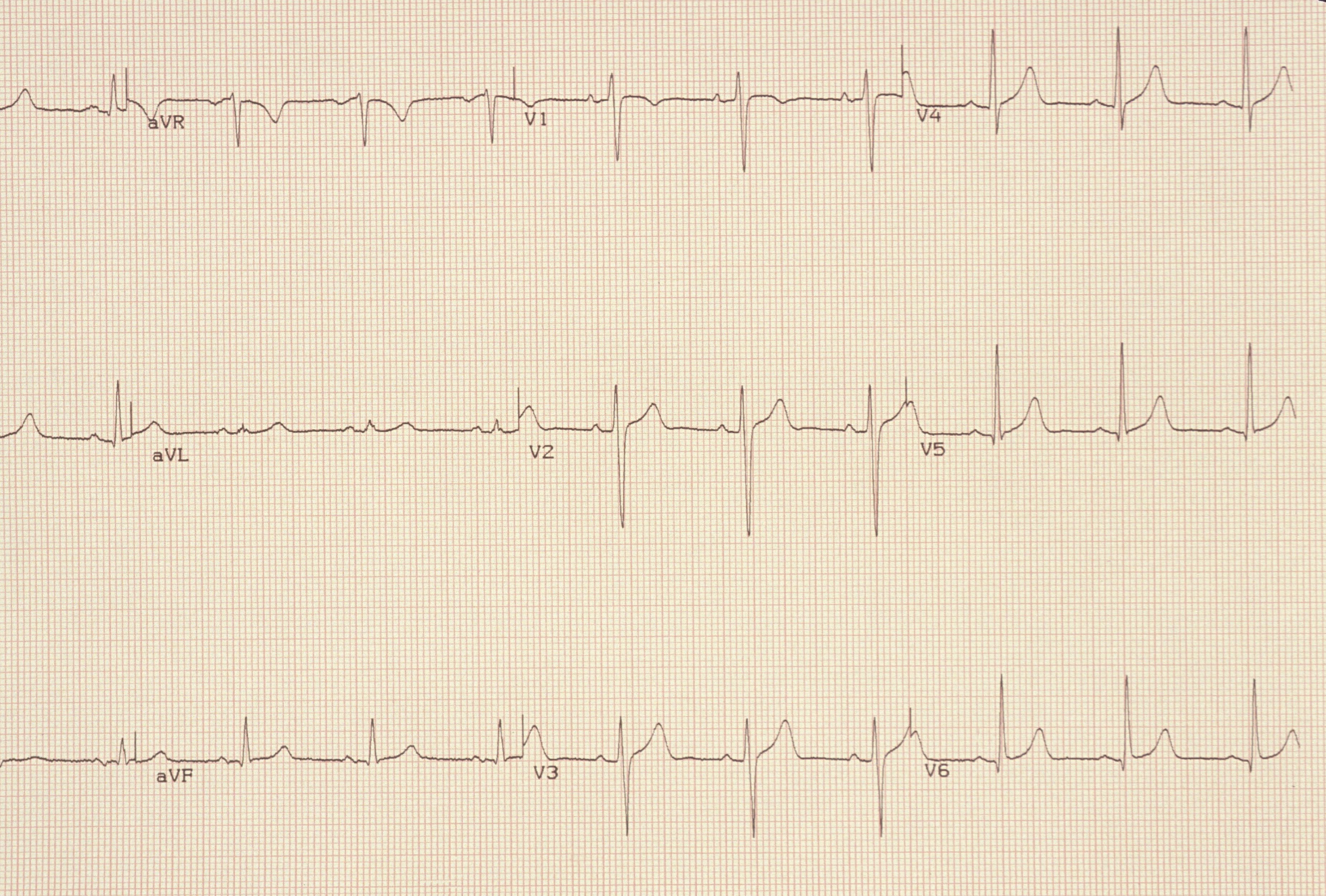 palpitations e heart test electrocardiogram The diagnosis for (ECG) cardiac