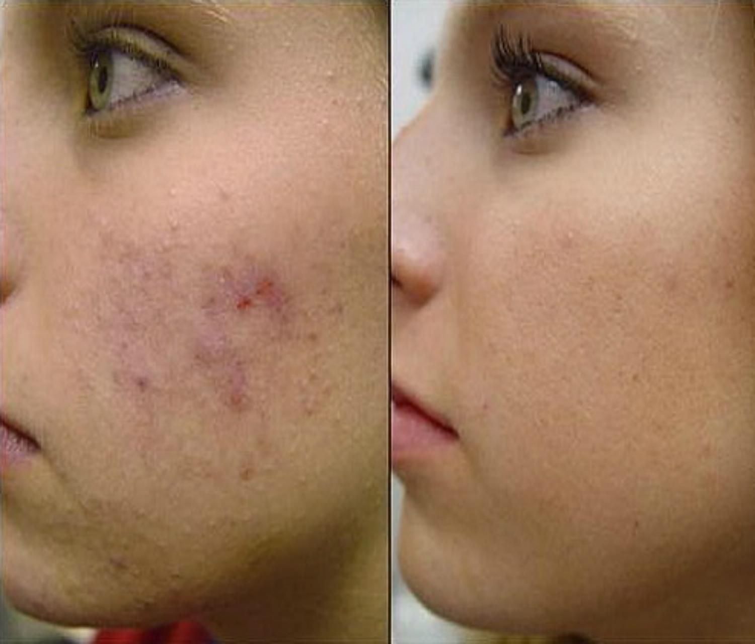 how-to-get-rid-of-acne-scars