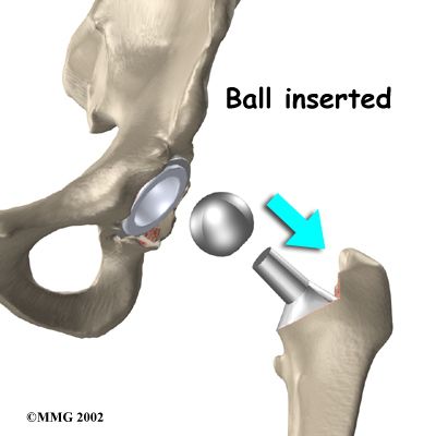 How a Hip Replacement Surgery Is Performed