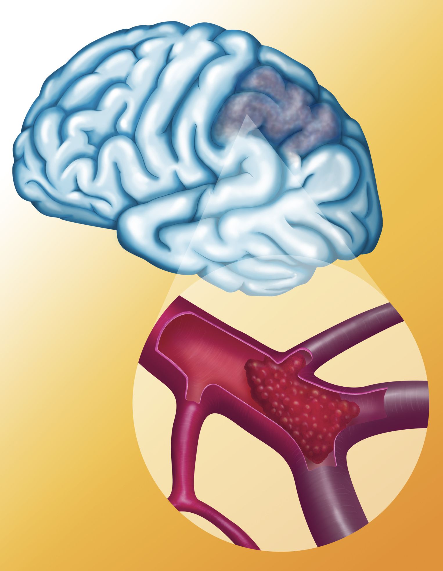 information-about-ischemic-stroke