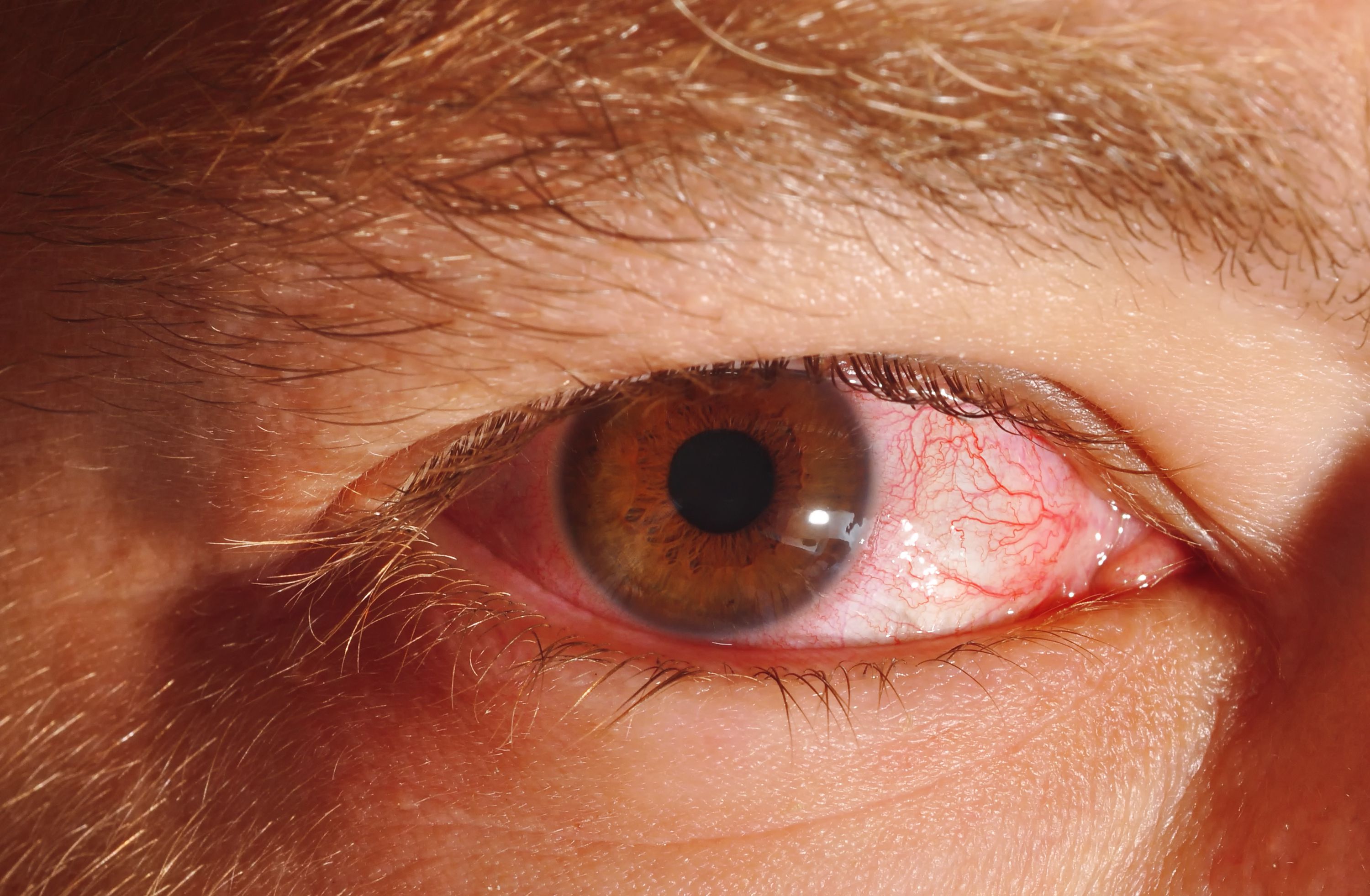 Eye Herpes Symptoms and Treatment3000 x 1963