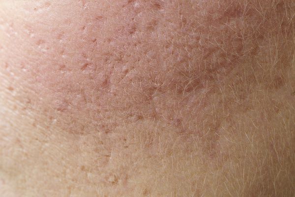 Skin Conditions - Symptoms, Treatment, and More