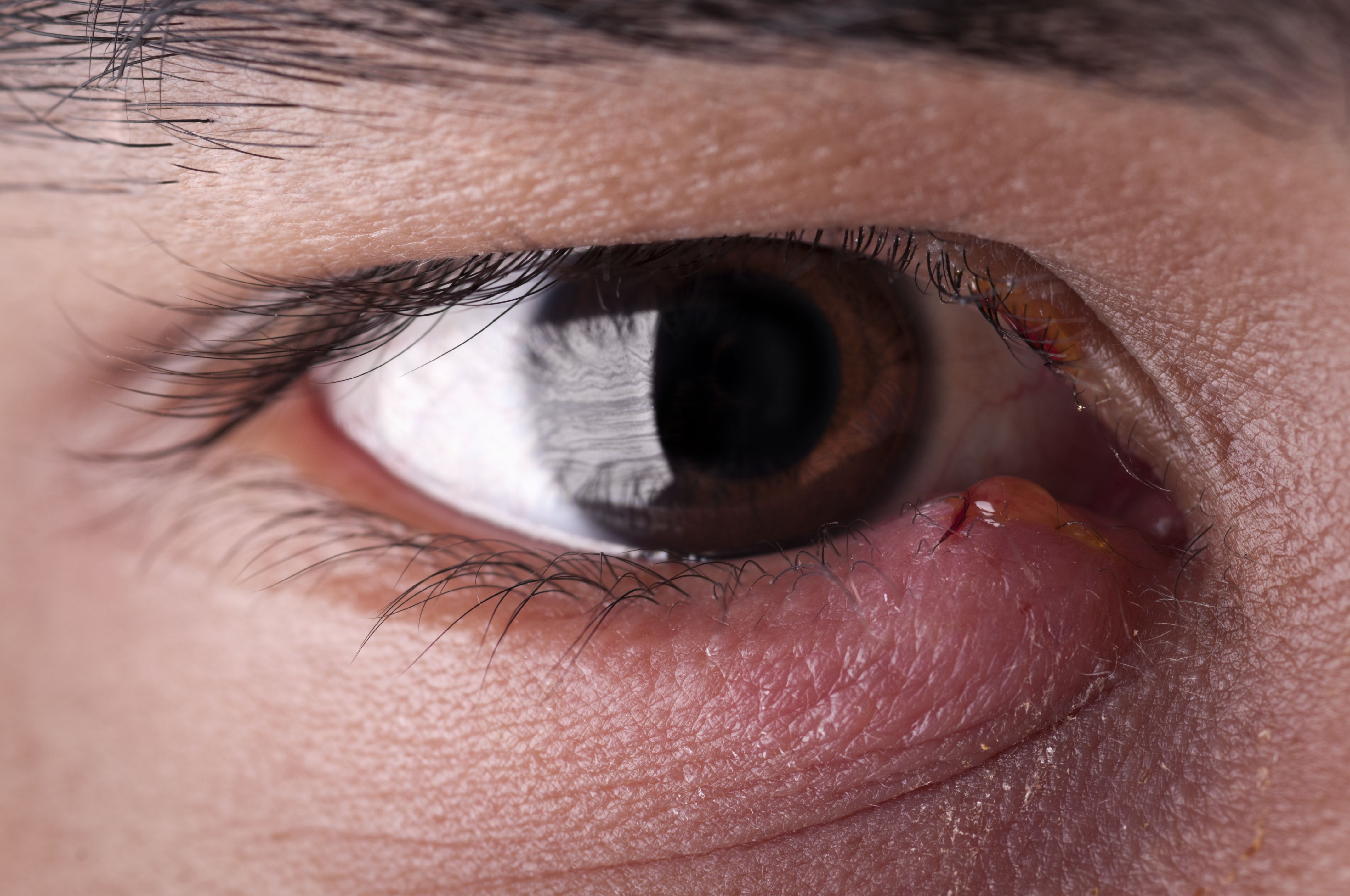 top-causes-of-swollen-eyelids