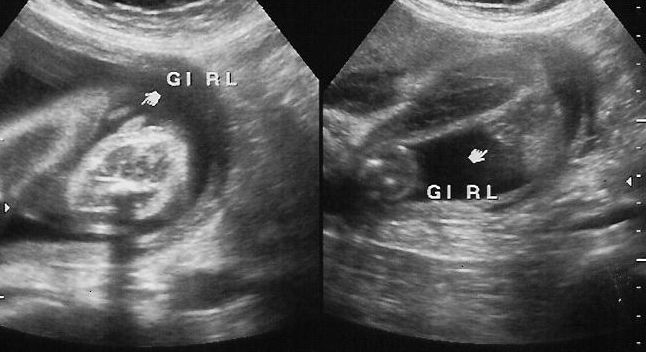 Female Baby Ultrasound