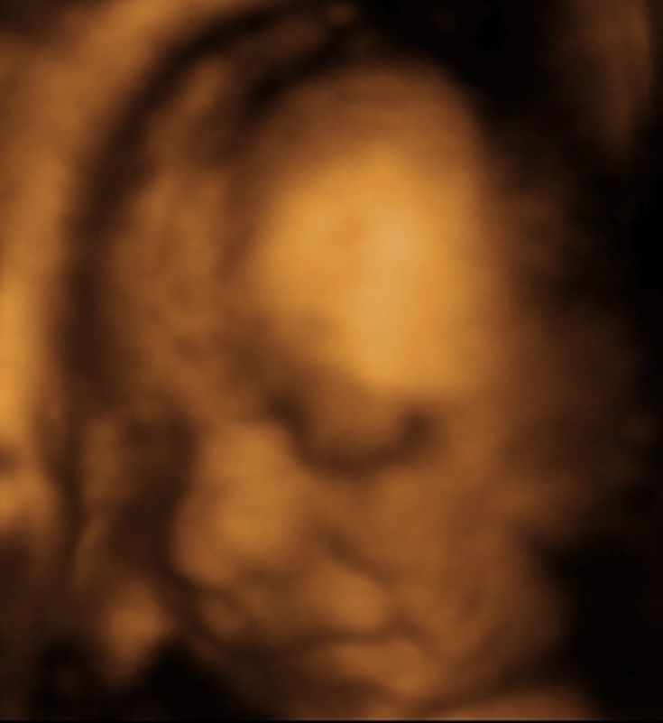 26 Weeks Pregnant Second Trimester Ultrasound Gallery