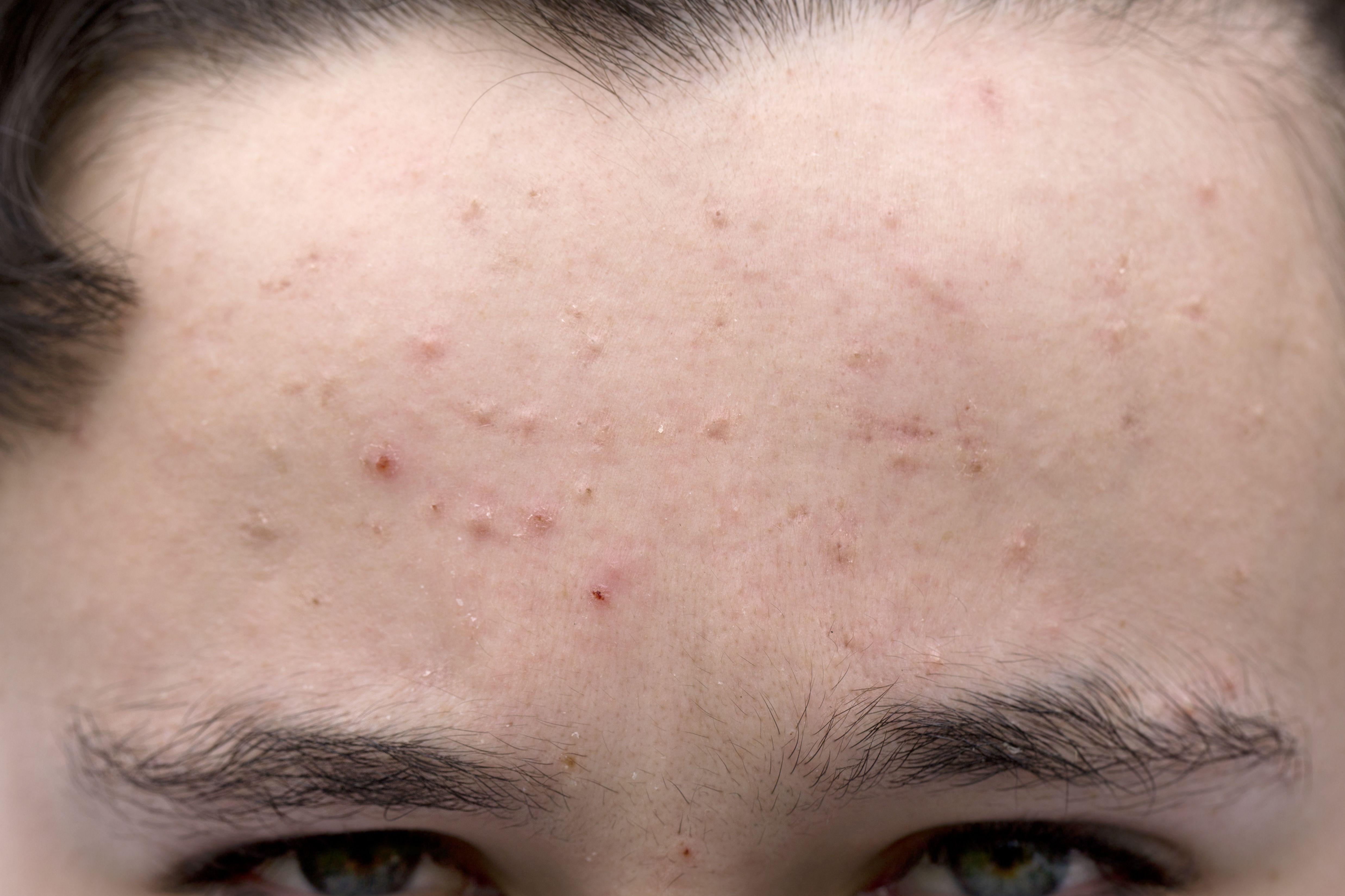 What Is Moderate Acne How Severe Is My Acne 