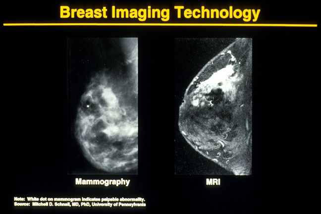 Mammogram Pictures With Descriptions Of Different Results