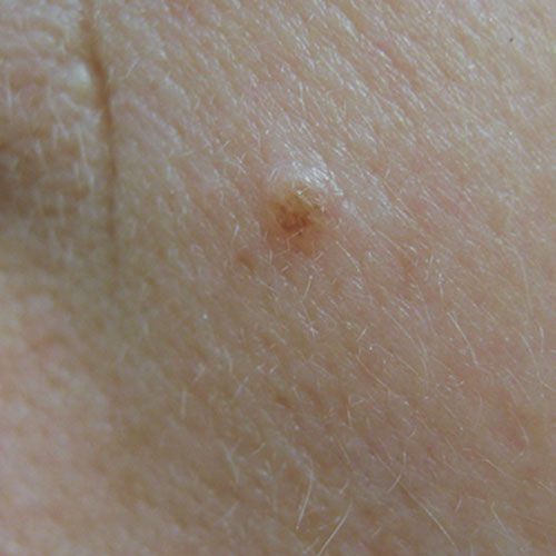 Find Out What Benign Moles Look Like   MolelightA500 56a2453a5f9b58b7d0c878e9 