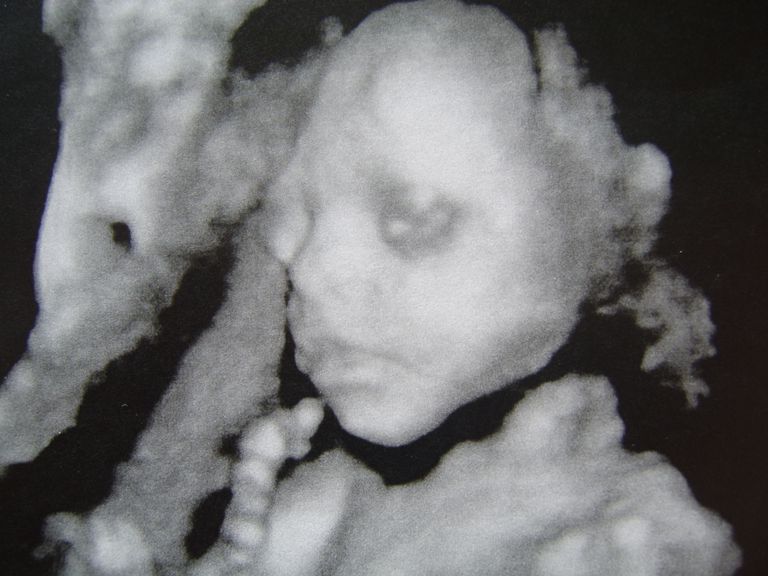 25 Weeks Pregnant - Second Trimester - Ultrasound Gallery