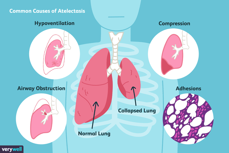 Causes and Treatment of Atelectasis (Collapsed Lung)