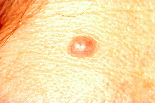 Spot the Differences Between a Mole and Skin Cancer