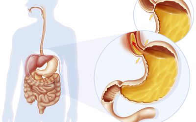 Acid Reflux and GERD in Infants