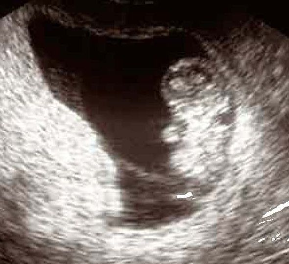 10th Week Pregnancy Ultrasound Photos