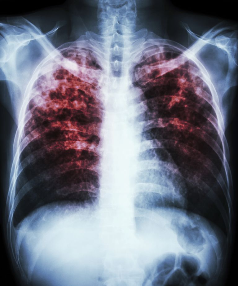 Tuberculosis Lungs