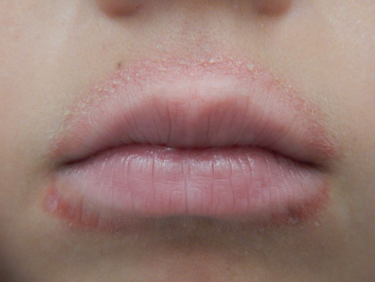 What Is Perioral Dermatitis?