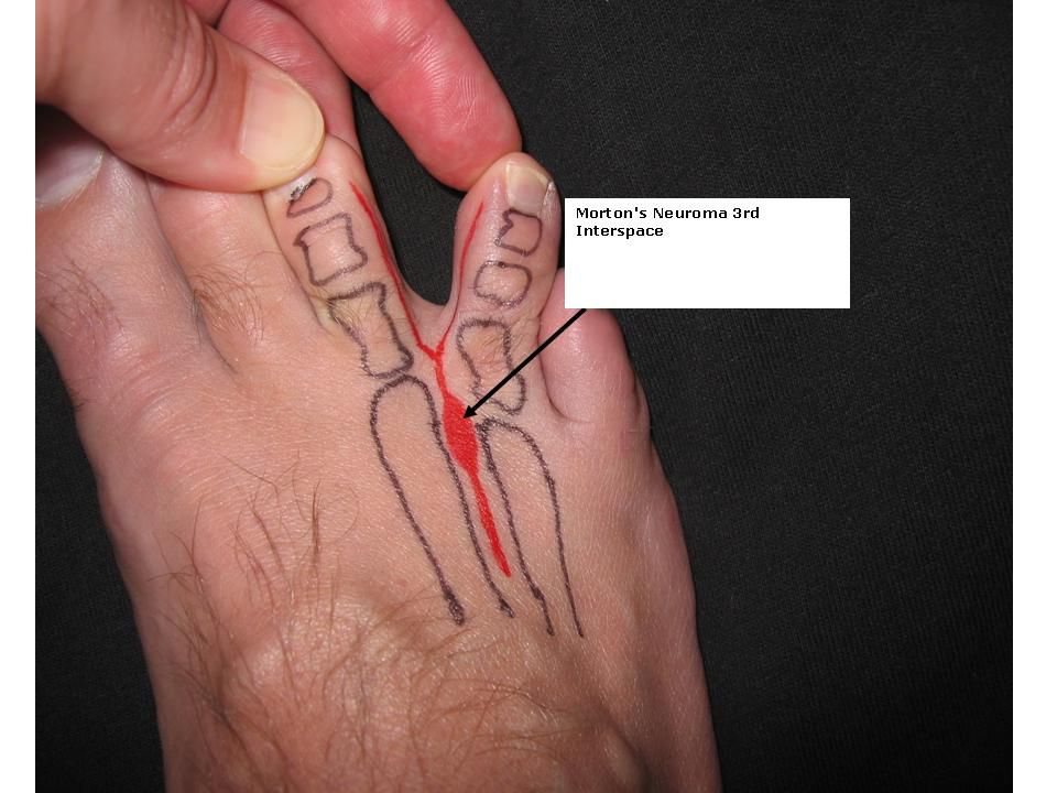 Morton's Neuroma Often Causes Fourth Toe Foot Pain