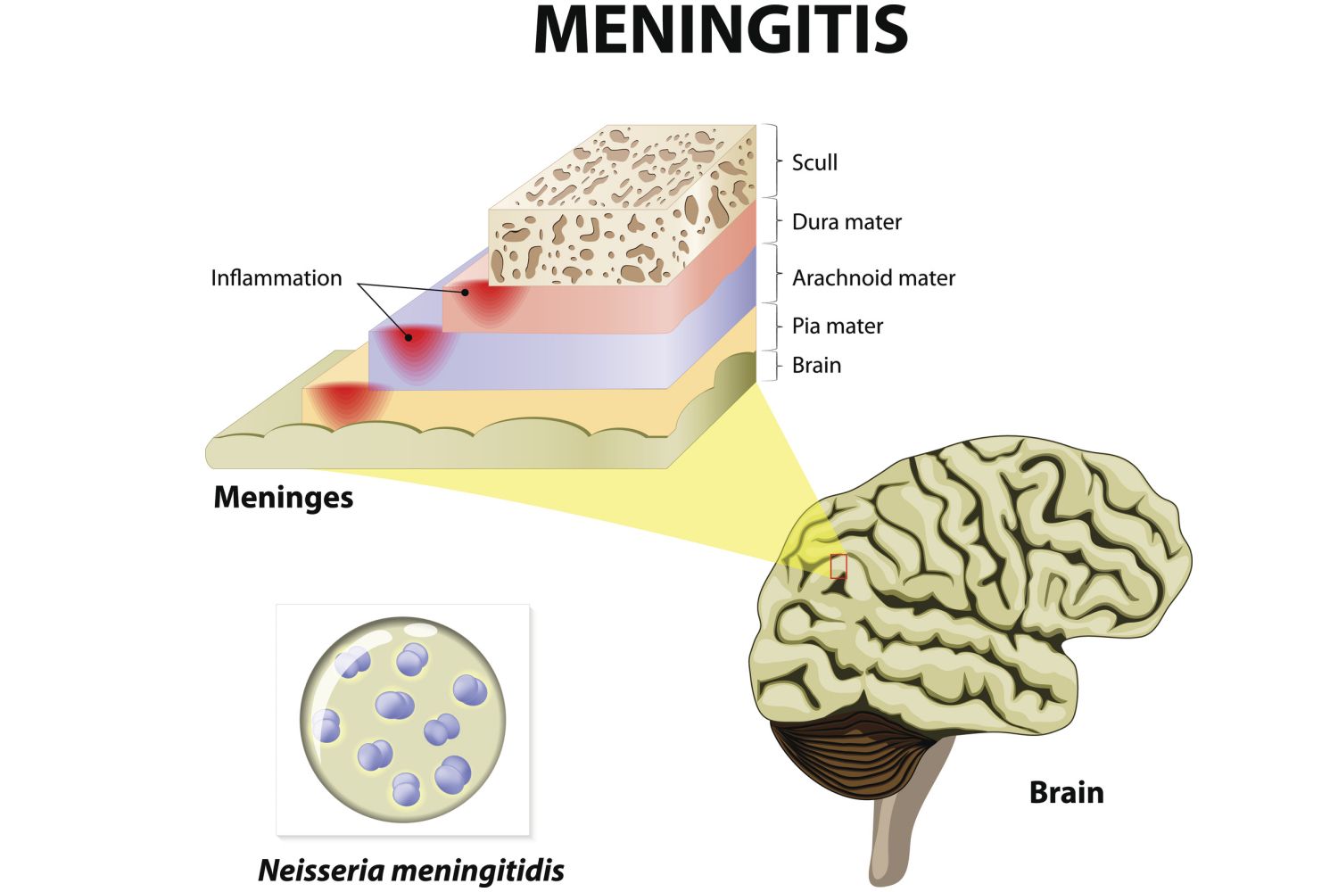 what-causes-meningitis-3-pathogens-responsible-for-the-infection