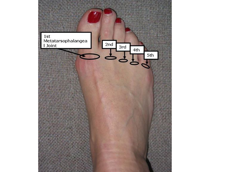 Understanding Metatarsophalangeal Mtp Joint Disorders