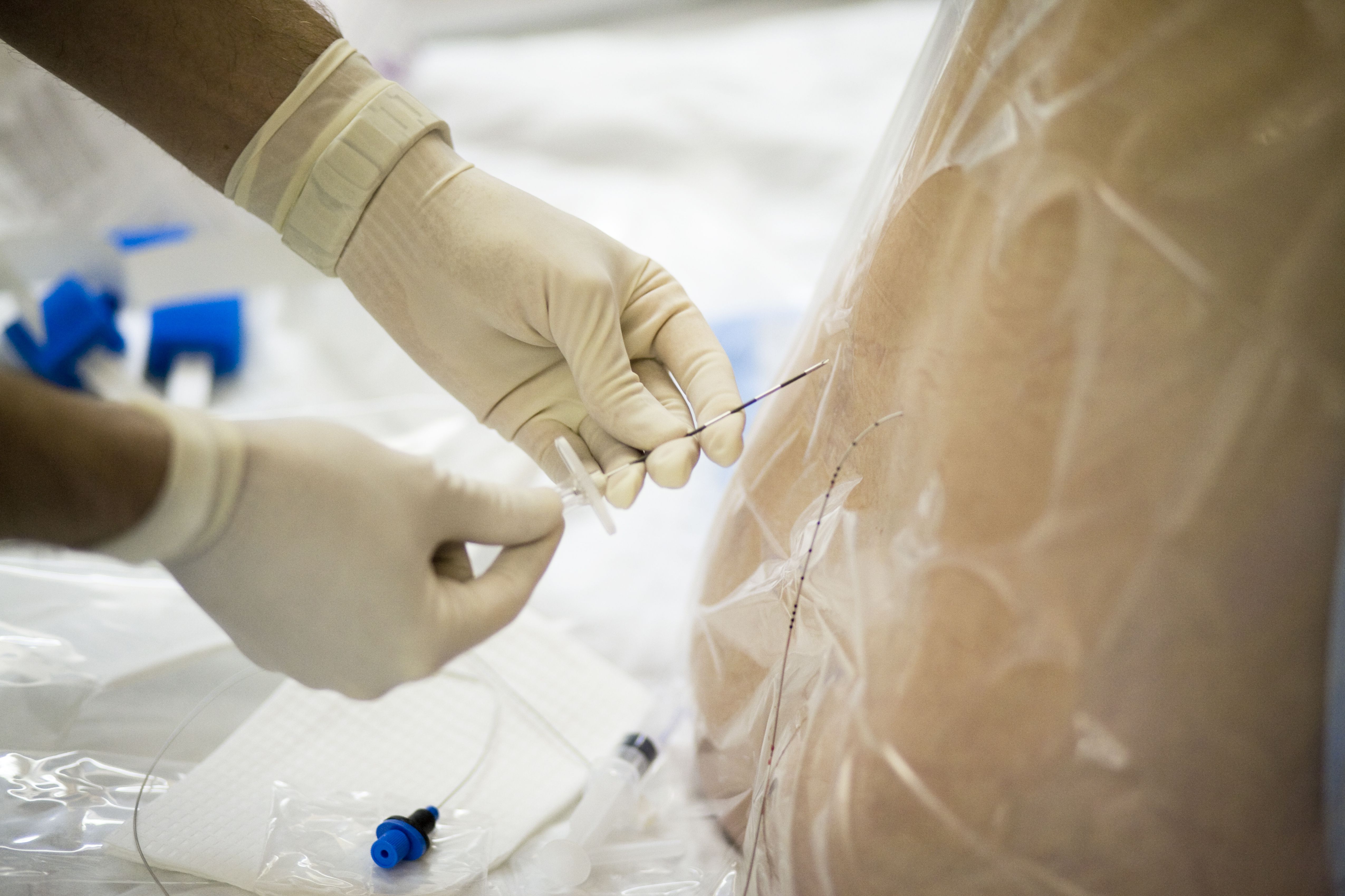 how-to-get-epidural-anesthesia