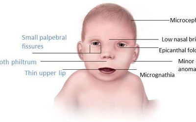 Fetal Alcohol Syndrome in the Classroom