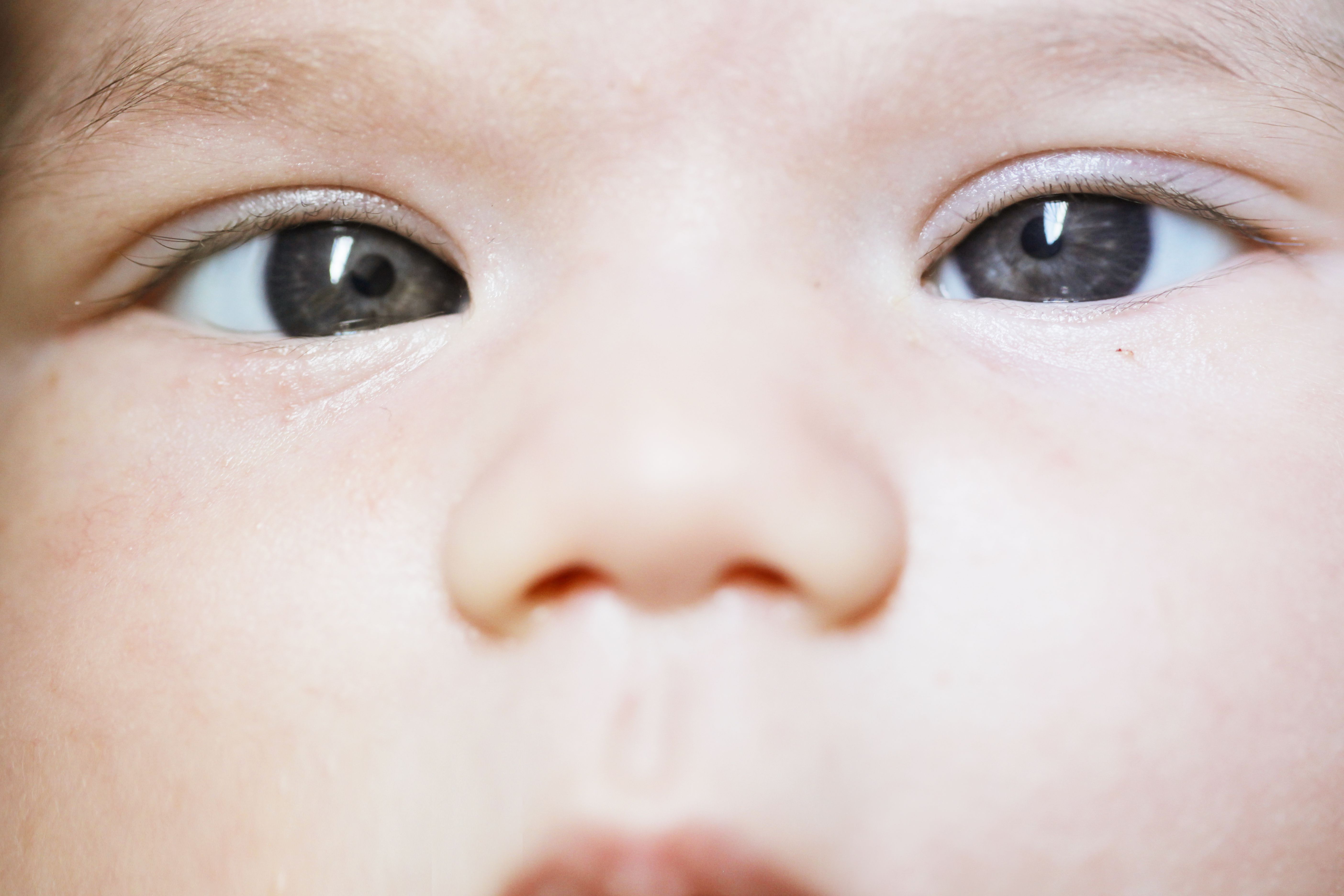 wandering eye in infants