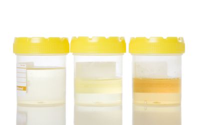 What Does Cloudy Urine Mean?