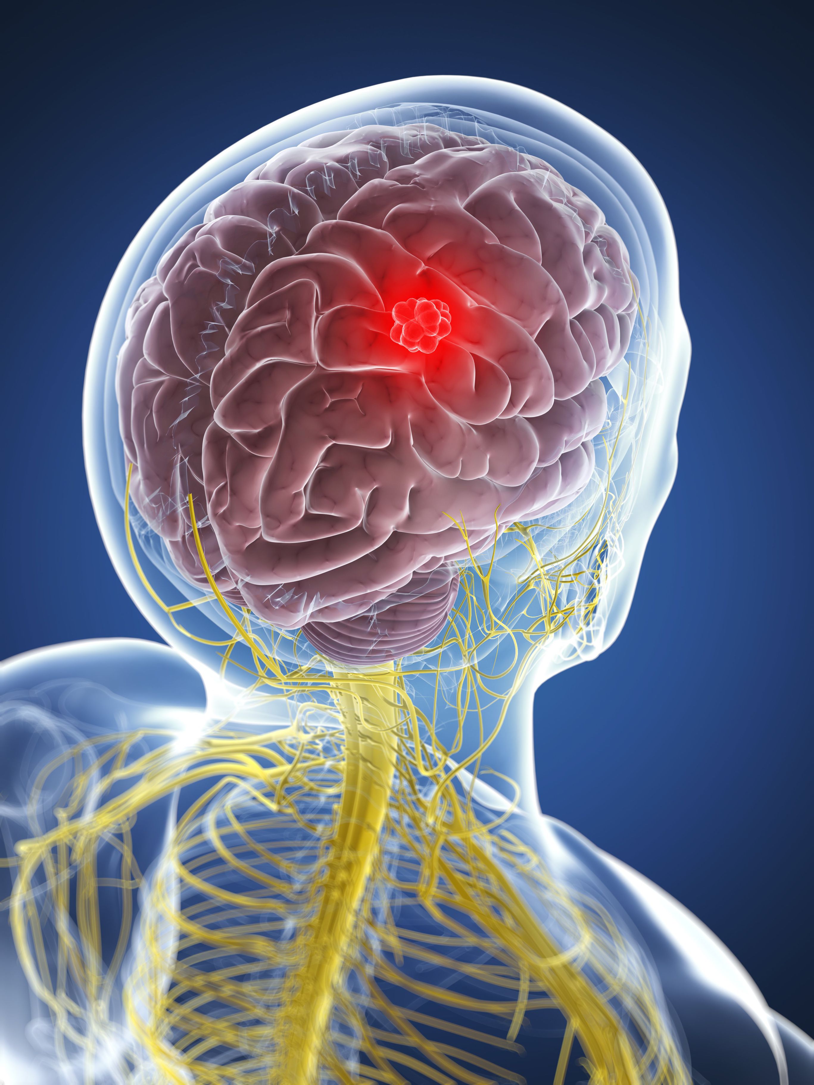 learn-basic-facts-on-brain-tumors