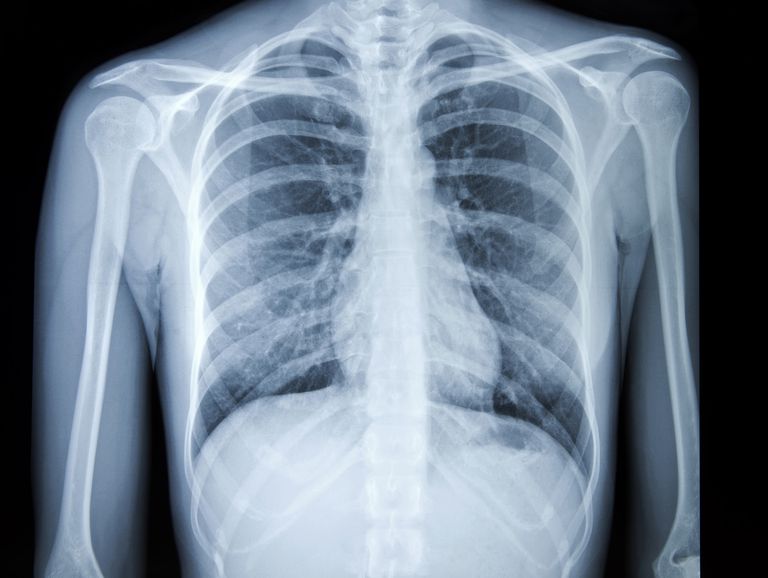 Chest X-Ray for Diagnosis of Lung Cancer