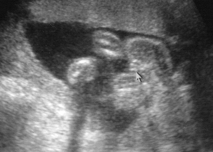 What Does a Baby Girl Look Like on Ultrasound?