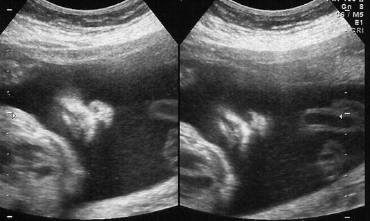 26 Weeks Pregnant - Second Trimester - Ultrasound Gallery