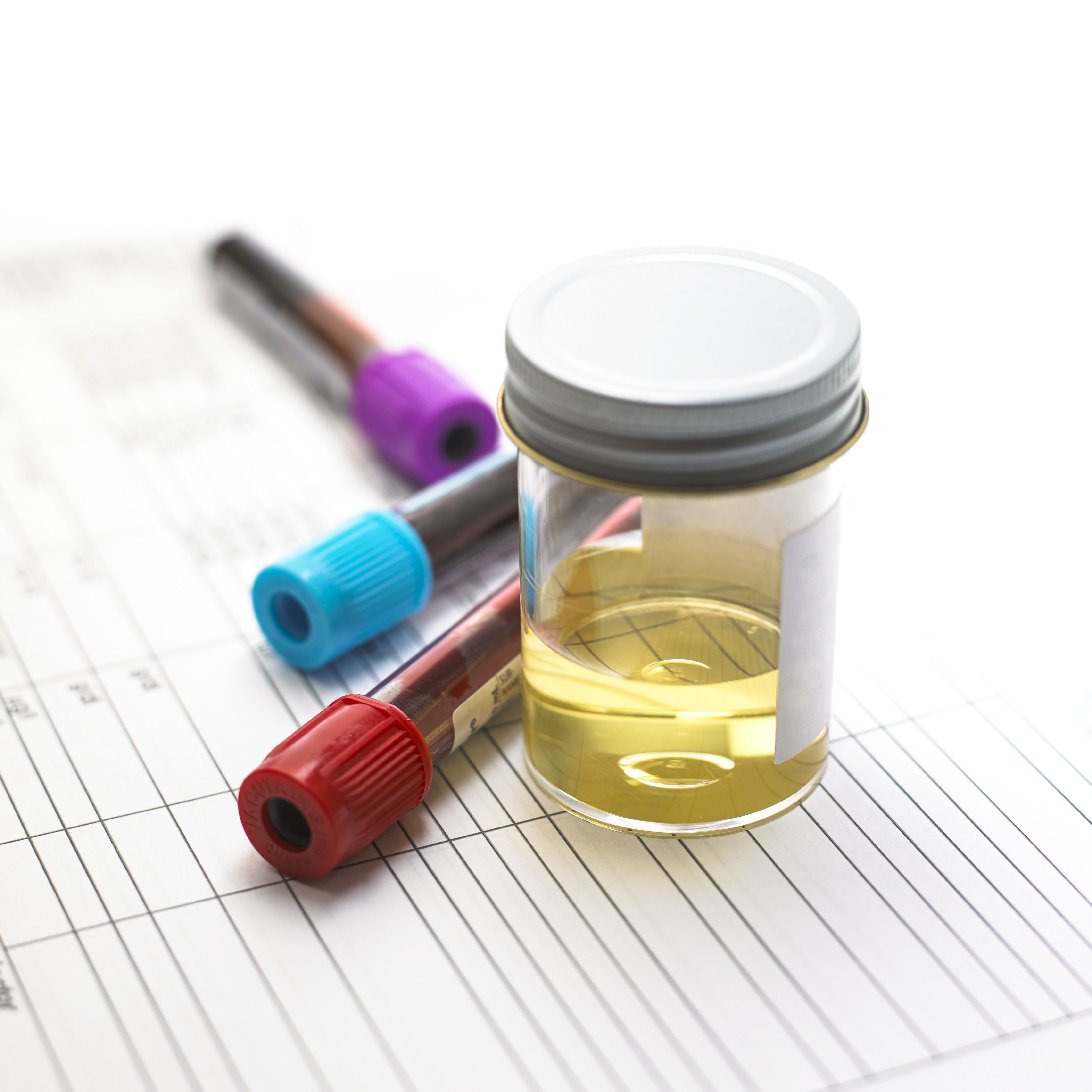 Urine Testing For Gonorrhea Chlamydia And Other Stds 6113