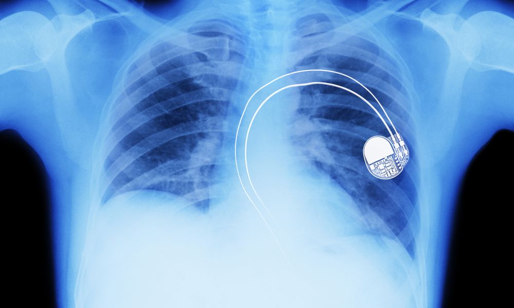 Pacemakers And Defibrillators