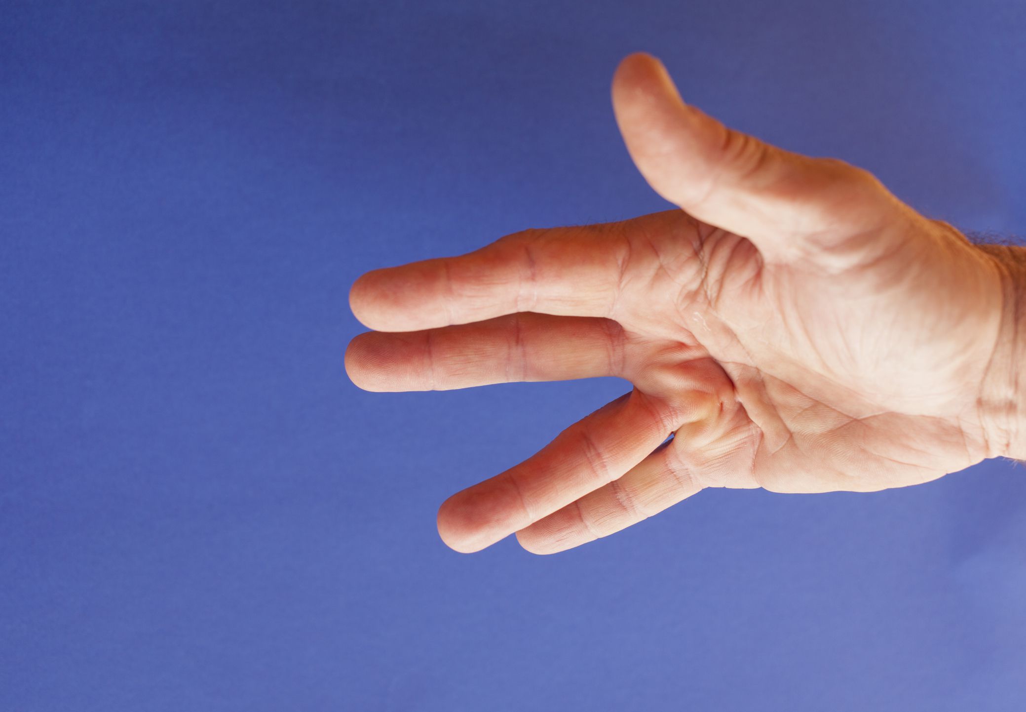 what-is-dupuytren-s-contracture