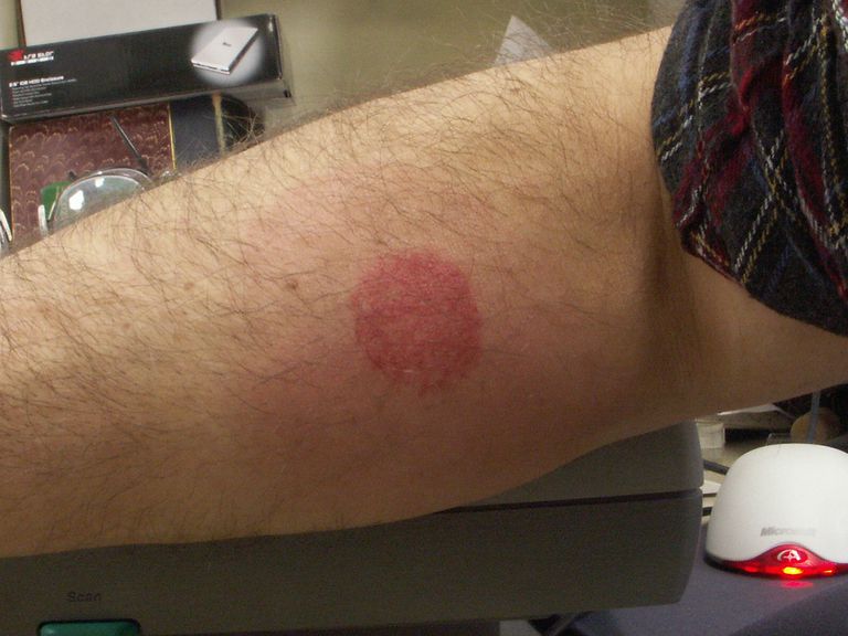 Gallery of Bed Bug Bites Pictures