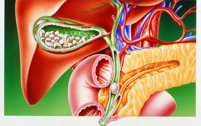 How Gallstones Are Diagnosed