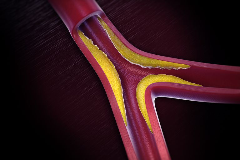 Smoking And Atherosclerosis Heart Disease