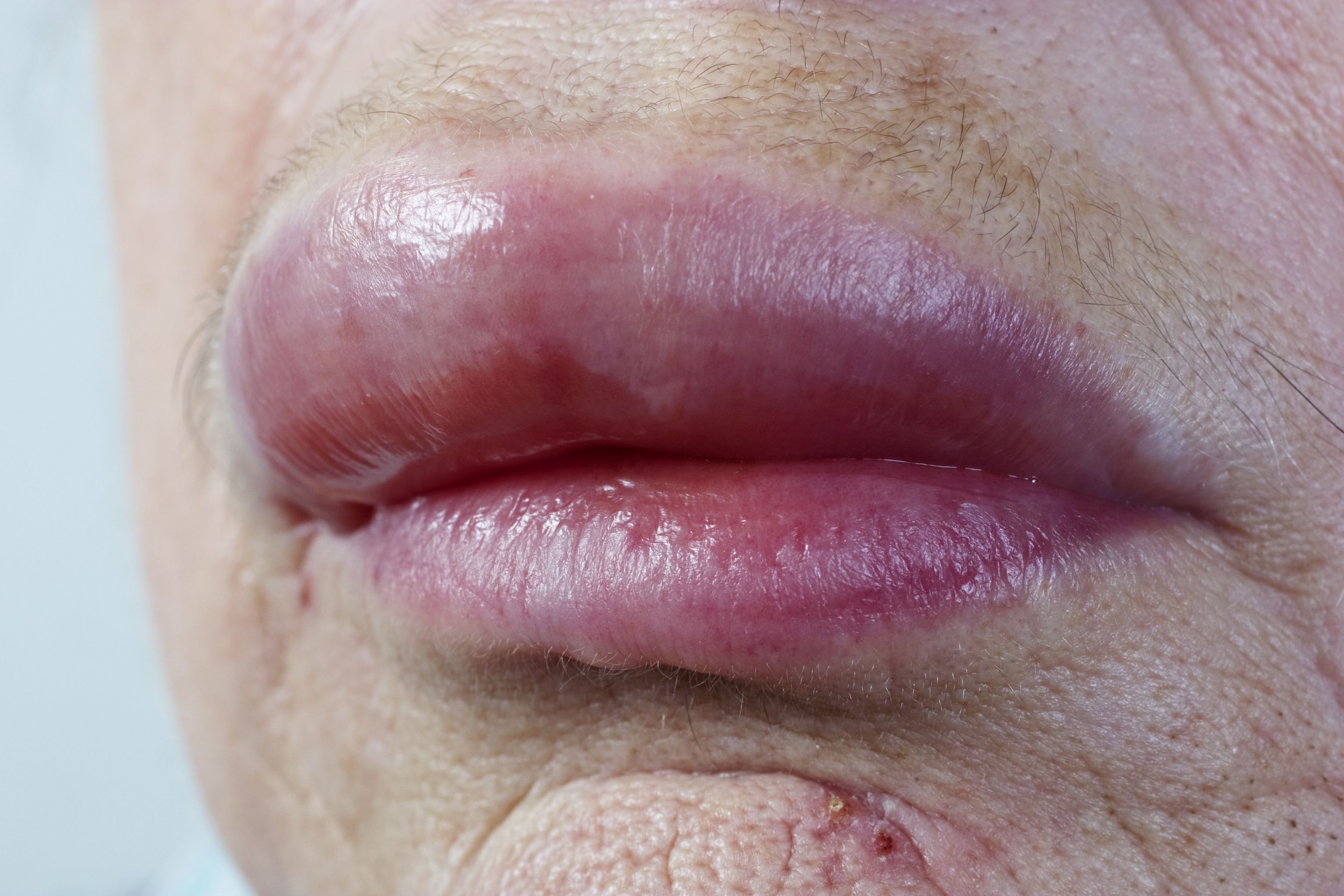 Allergic Reaction On Lips Eczema on the lips Types, triggers, causes