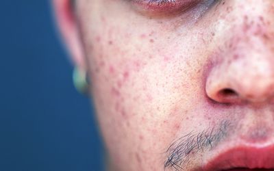 What to Expect From Retin-A Acne Treatment