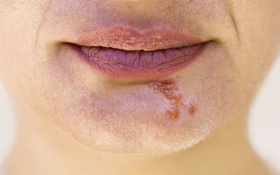 How to Get Rid of Pimples Fast
