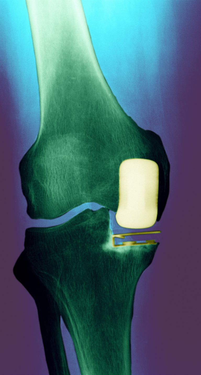 robotic-partial-knee-replacement-prestige-sports-medicine