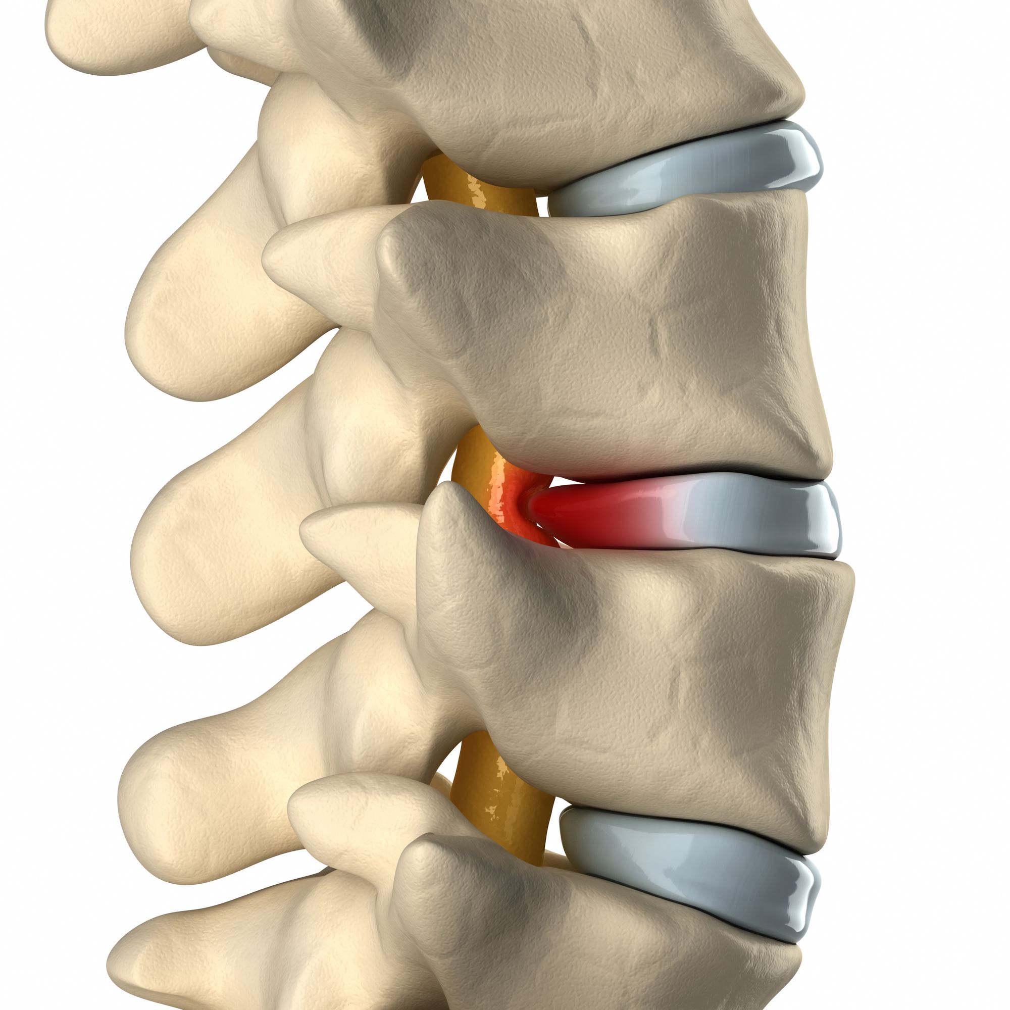 central-canal-stenosis-symptoms-and-causes