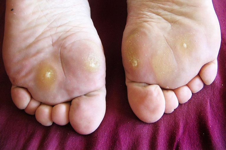 How to Identify and Treat Plantar Warts