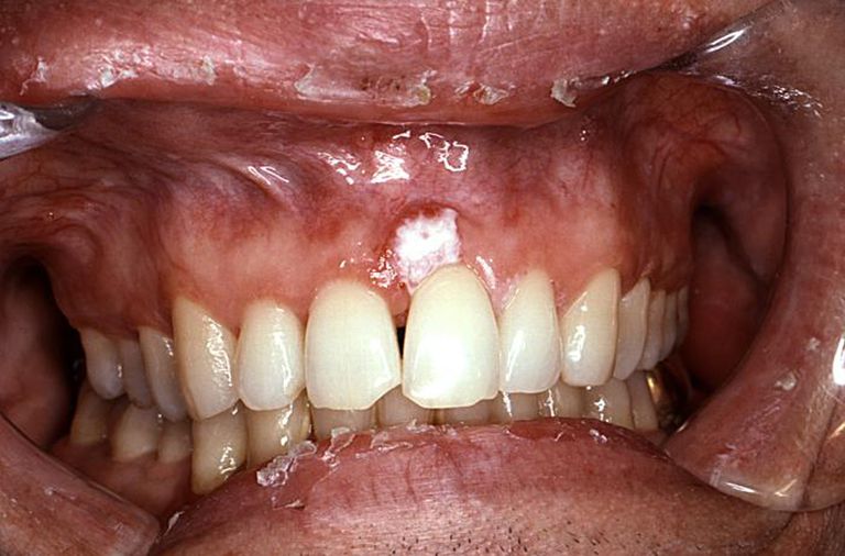 what-does-oral-cancer-look-like