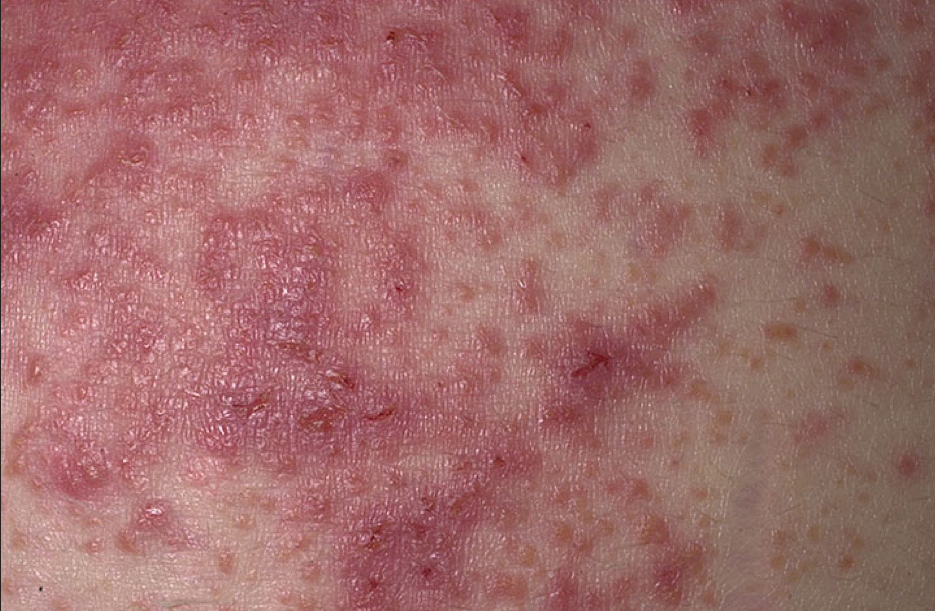 Dermatitis Herpetiformis (Celiac Disease Rash) Photos