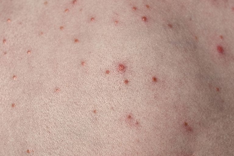 10-common-bacterial-skin-infections