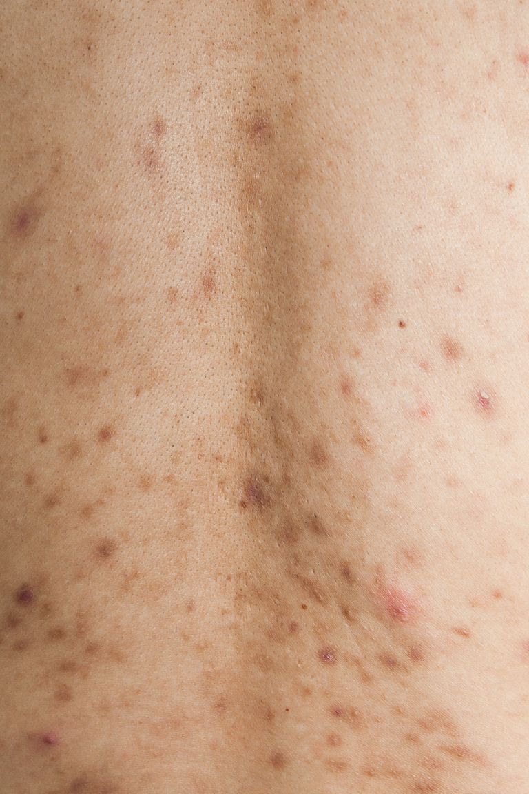 Post-Inflammatory Hyperpigmentation and Acne