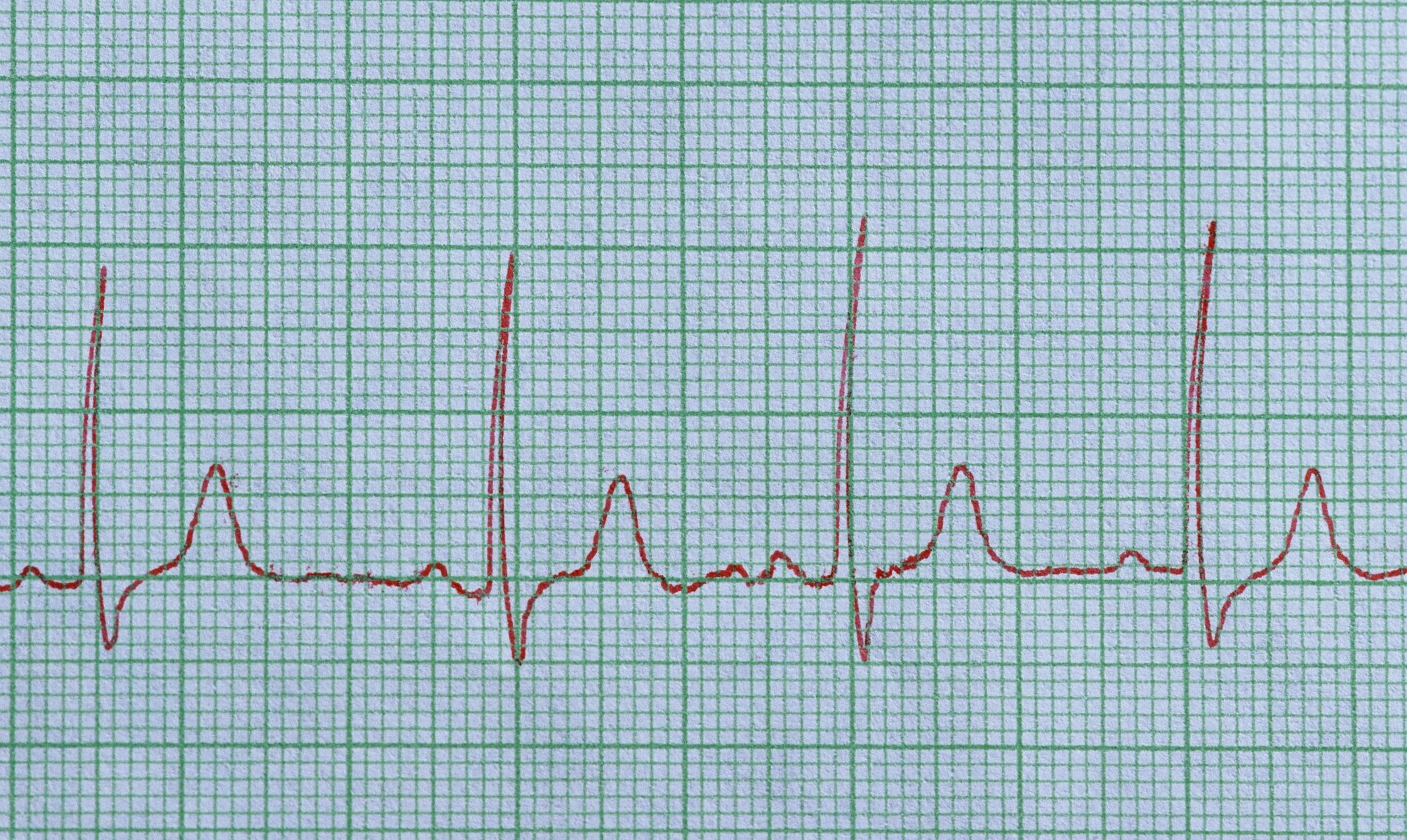 what-to-know-about-normal-sinus-rhythm