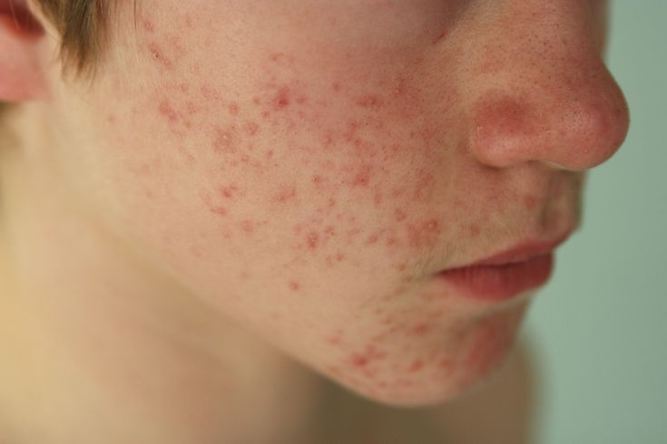 What Is Rosacea? - Definition in Acne