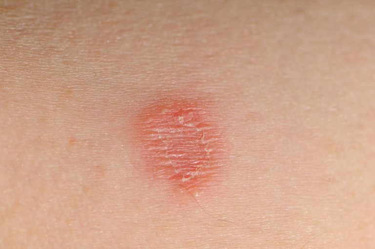 ringworm-symptoms-causes-diagnosis-treatment