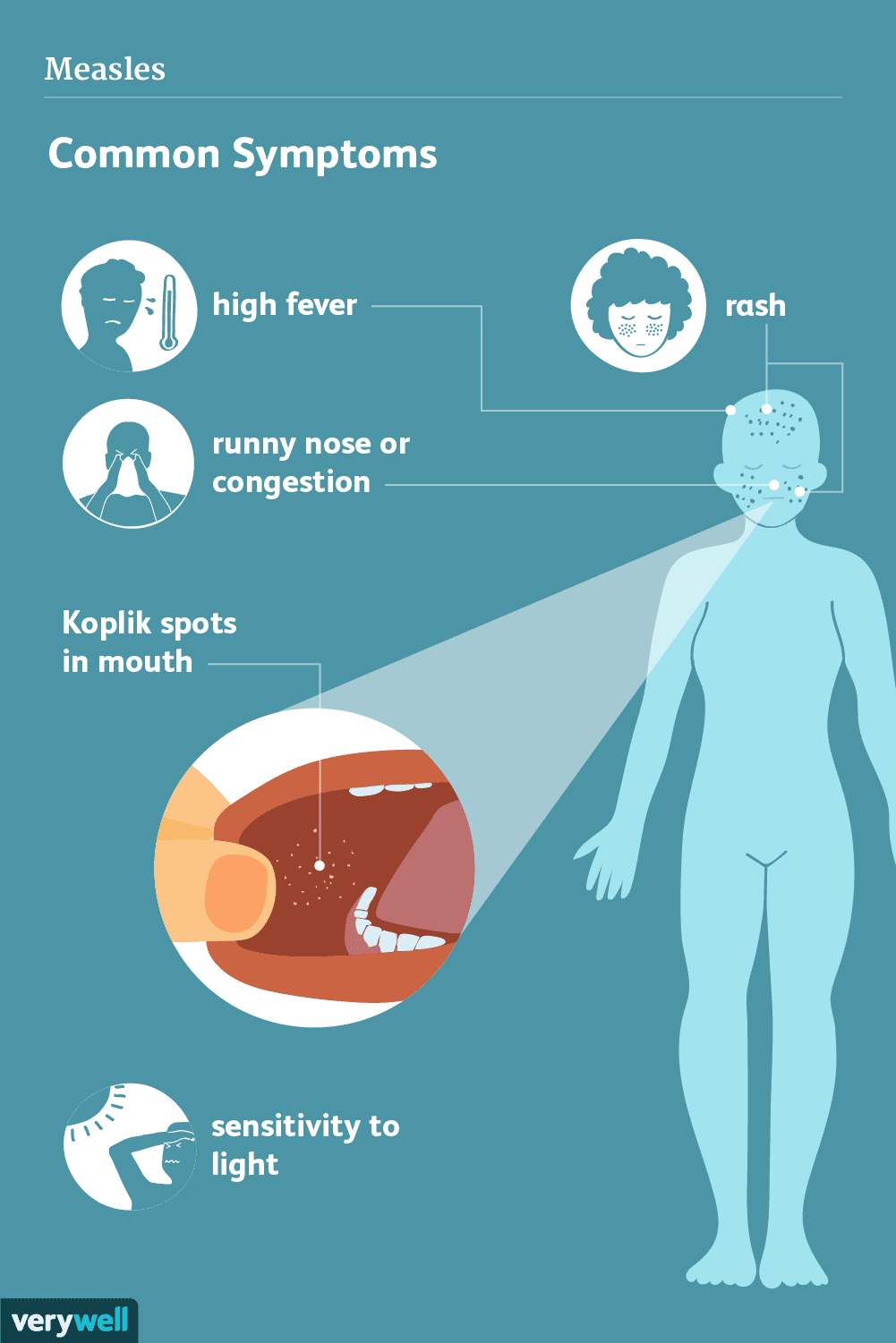 Measles: Signs, Symptoms, and Complications